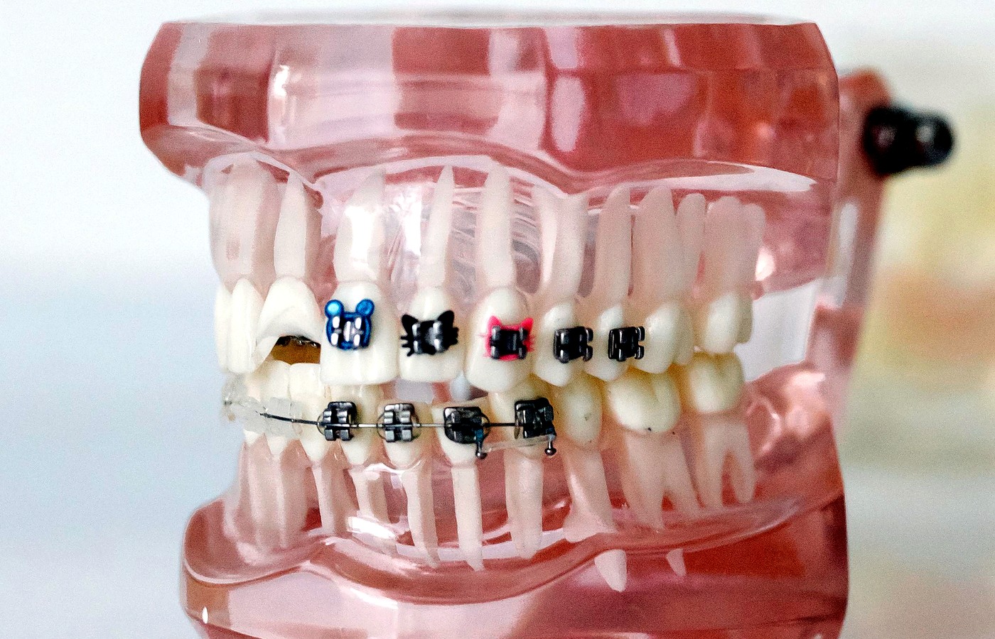 Modelo dental con aparato de ortodoncia